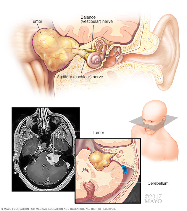 Acoustic Neuroma Beacon Health System