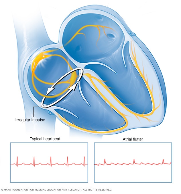 Atrial fibrillation ablation Beacon Health System