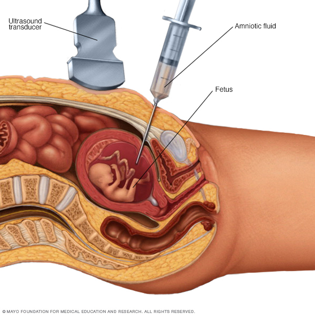 Amniocentesis Beacon Health System