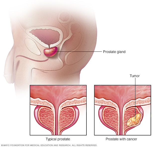 A normal prostate versus a prostate with a tumor