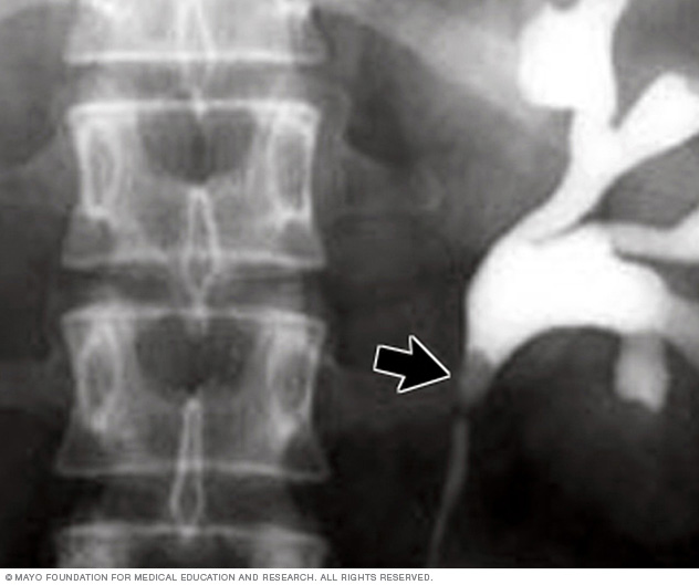 X-ray image of kidney stone