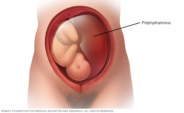 Excess amniotic fluid surrounding baby in the uterus (polyhydramnios)