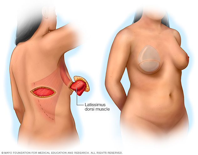 Illustration showing a pedicle latissimus dorsi flap procedure 