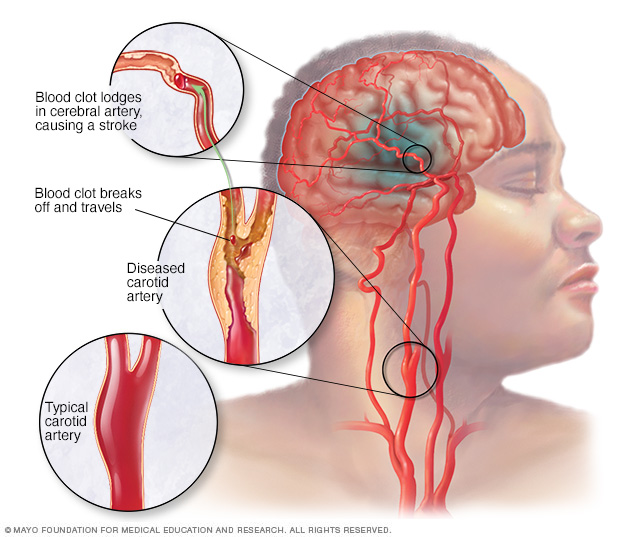 A diseased carotid artery and a blood clot in a cerebral artery