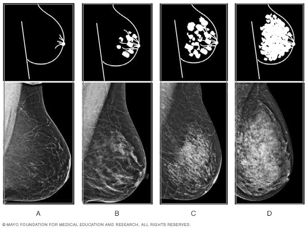 Mammogram films showing the four levels of breast density