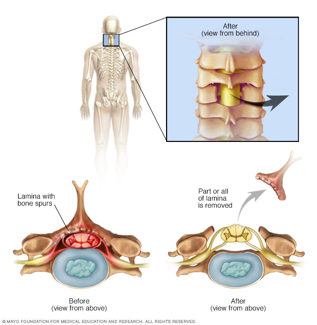 Removal of rear portion of a vertebra in neck