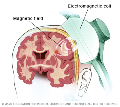 Repetitive transcranial magnetic stimulation (rTMS)