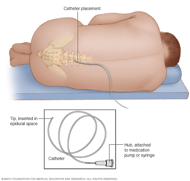 Placement of epidural catheter