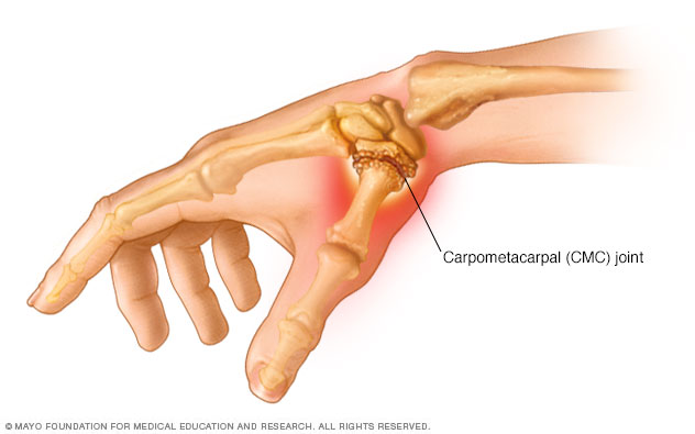 Thumb arthritis 