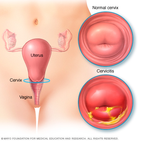 Illustration of normal cervix and cervix with cervicitis 
