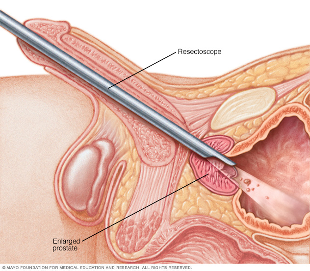 How surgery to remove excess prostate tissue is done