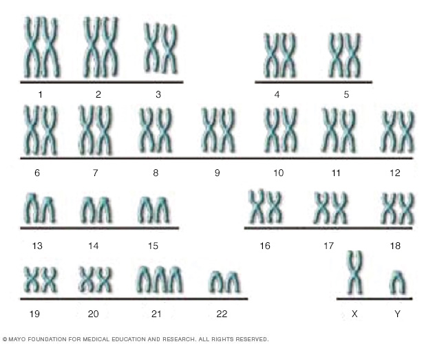 Illustration showing the chromosomes of someone with Down syndrome