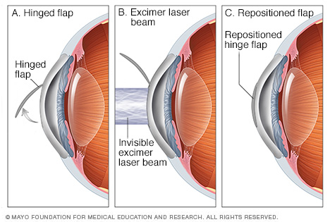 LASIK eye surgery 