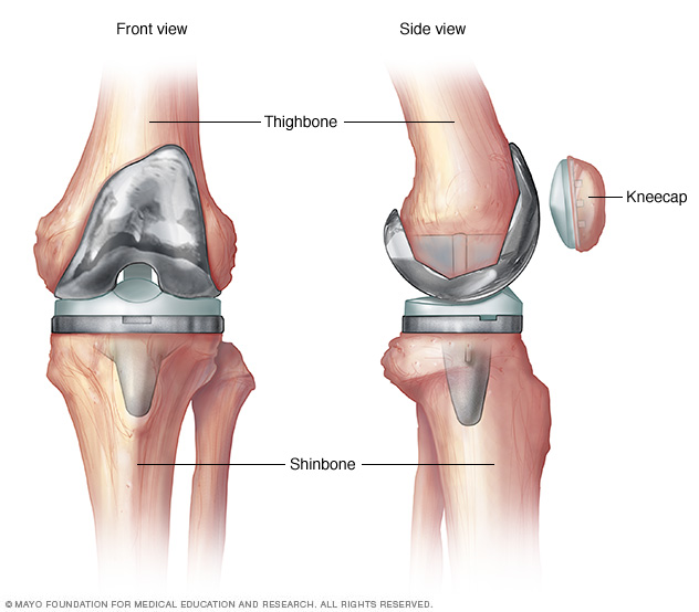An artificial knee