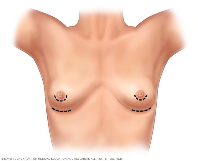 Breast incisions for breast augmentation