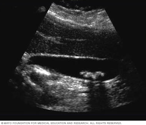 Ultrasound image of gallstones 

