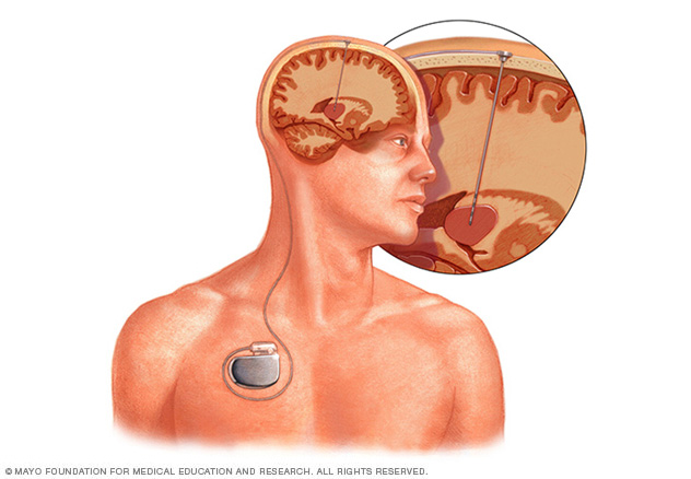 Electrode placement and device location in deep brain stimulation