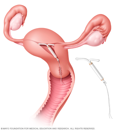 Mirena IUD in place in the uterus