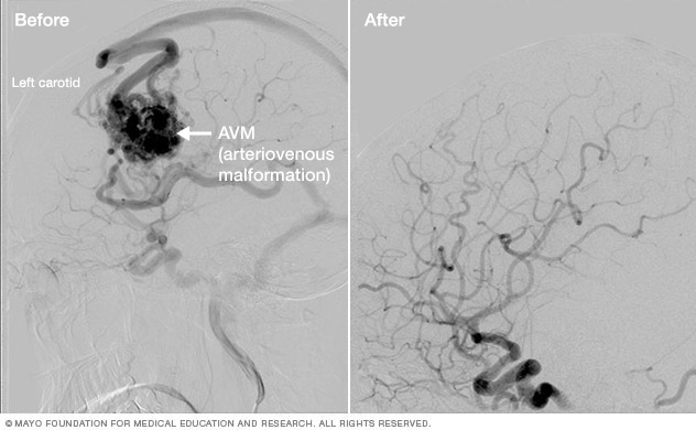 Brain arteriovenous malformation treatment results