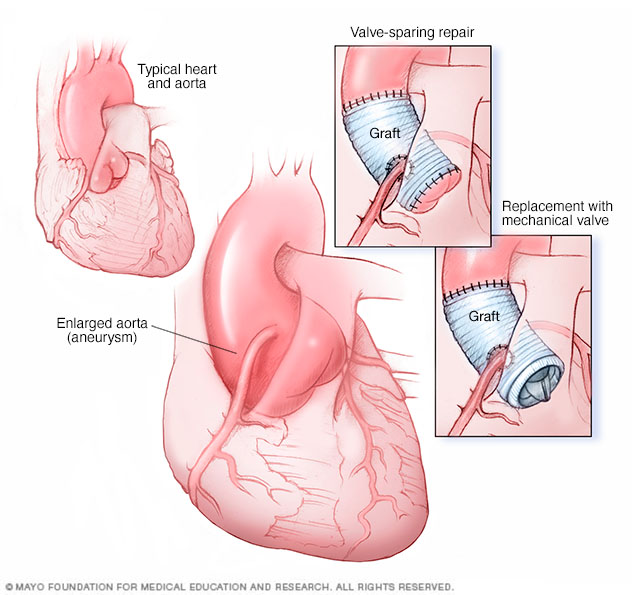 Illustration showing an ascending aortic root aneurysm repair and replacement