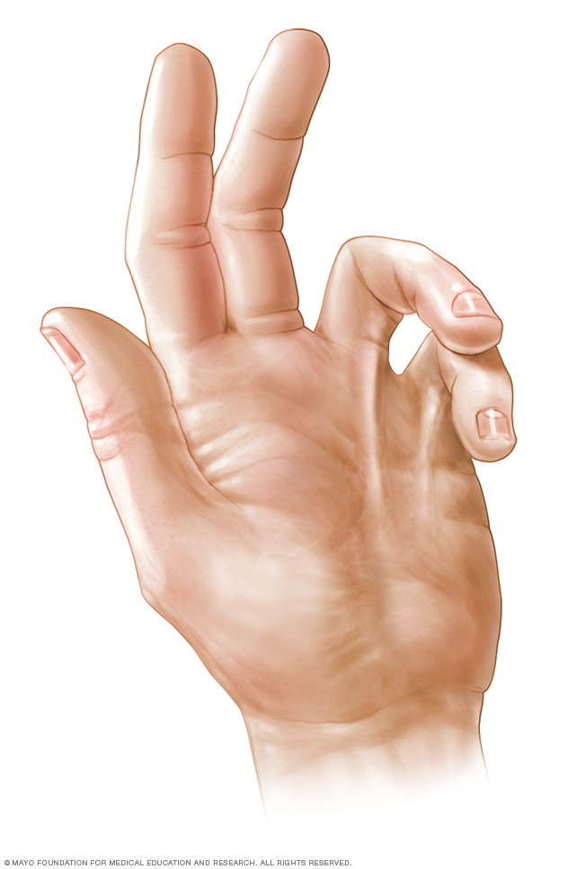 A hand with Dupuytren's contracture