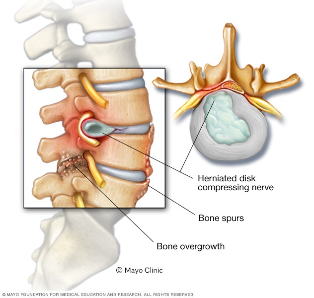Herniated disk with bone spurs