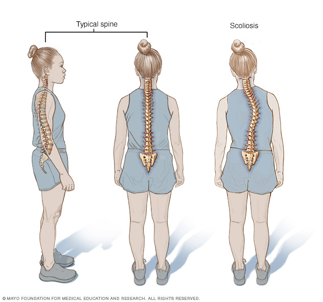 Comparing normal curves in spine with scoliosis