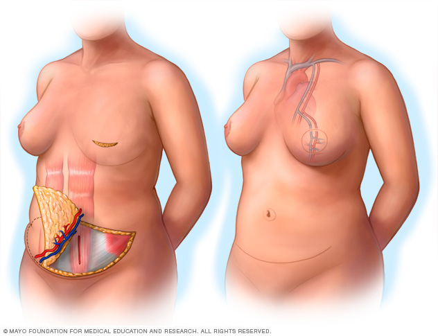During and after images of breast reconstruction using the DIEP flap procedure