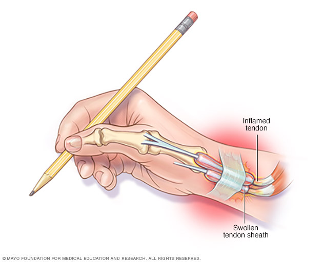 Irritated tendons in wrist