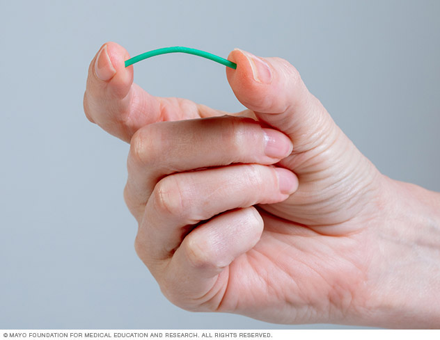 Photo of contraceptive implant