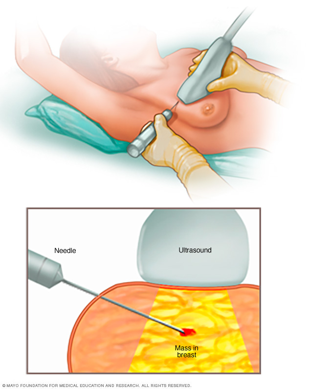 Core needle biopsy