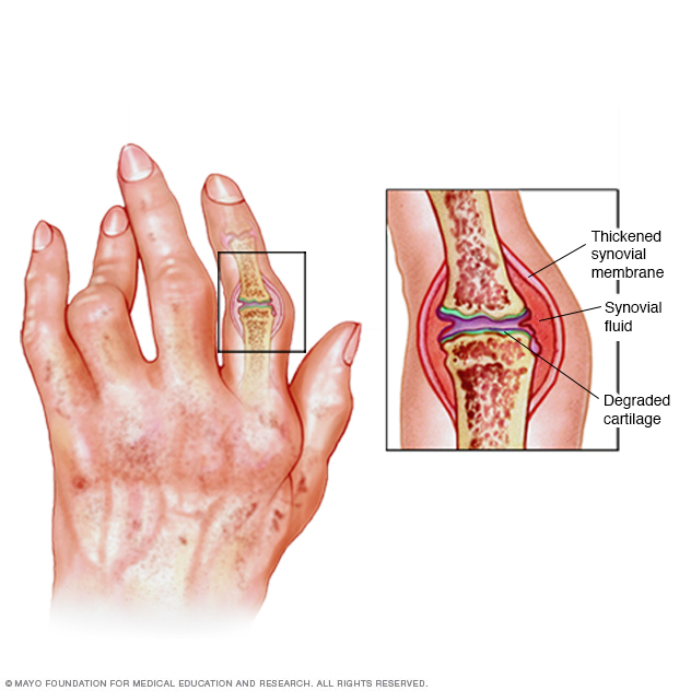 Inflammation of rheumatoid arthritis