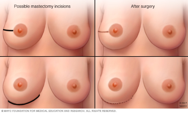 Common incisions used during nipple-sparing mastectomy