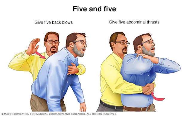 First aid for a choking person