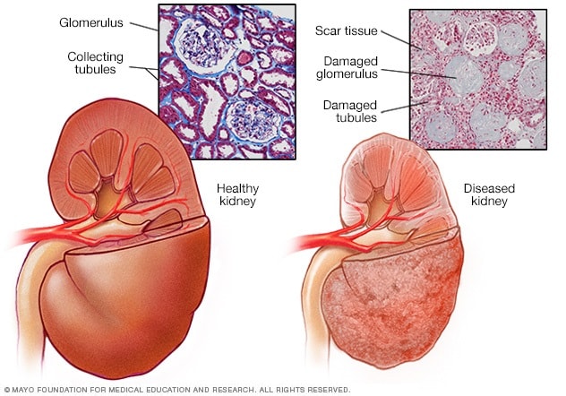 A healthy kidney and a diseased kidney