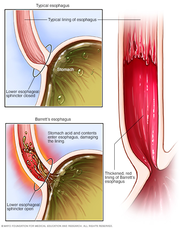 bpc 157 barrett's esophagus Barrett's Esophagus: Symptoms, Diagnosis &