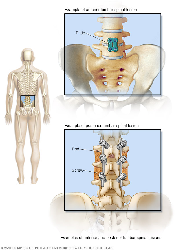 Illustration showing hardware used to fuse lumbar spine.