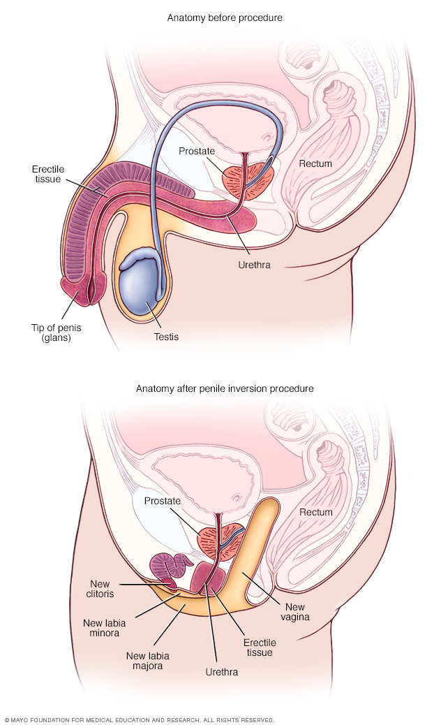 Anatomy before and after penile inversion