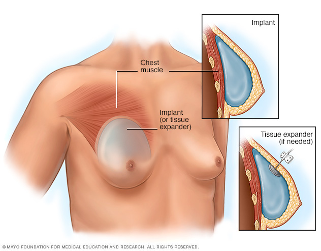 Placement of breast implants or tissue expanders