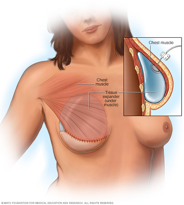 Illustration showing tissue expansion 