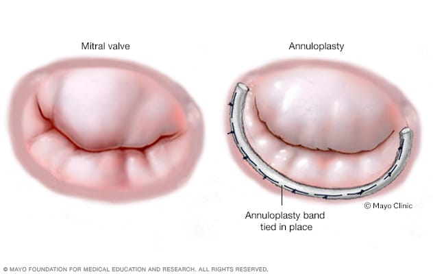 An annuloplasty