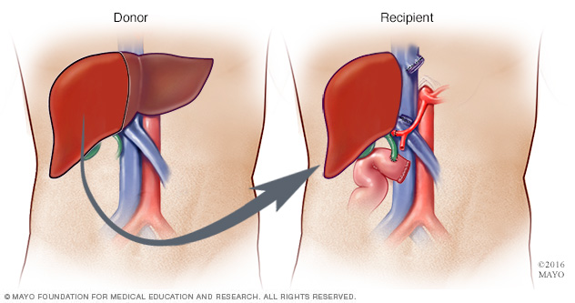 Living-donor liver procedure