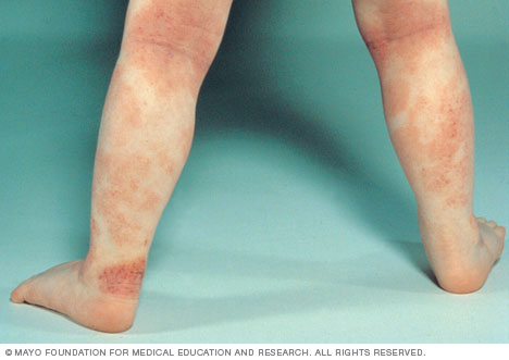 Infantile eczema