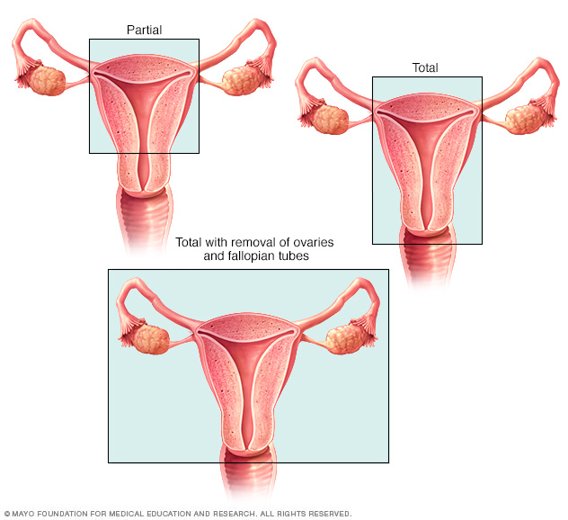 Types of hysterectomy