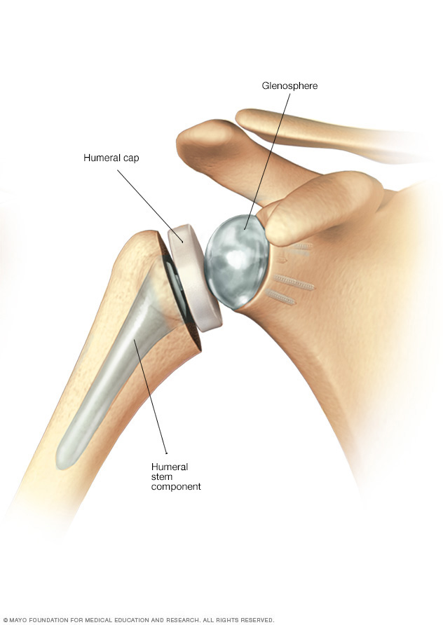 Reverse total shoulder replacement