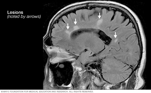 Multiple sclerosis lesions on the brain