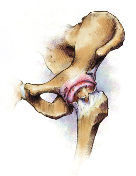 Diseased hip