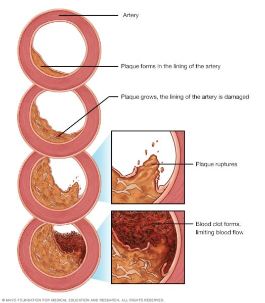 Plaque and blood clots can reduce blood flow through an artery.
