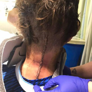 Brock Meister surgery incision