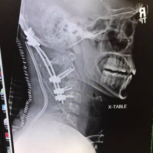 Brock Meister’s X-ray showing the extent of injuries that needed repair.